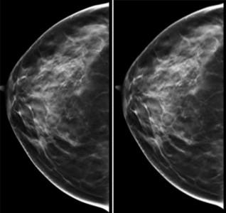 breast_tomosynthesis_3