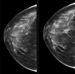 breast_tomosynthesis_4