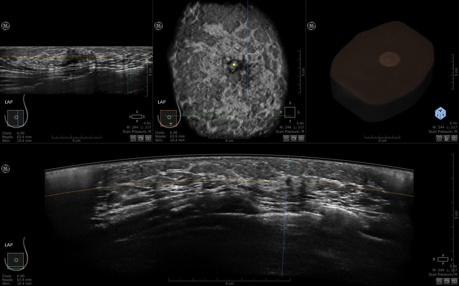 3 D Automated Breast Ultrasound Abus Διαγνωστική Μαστογραφία 5054